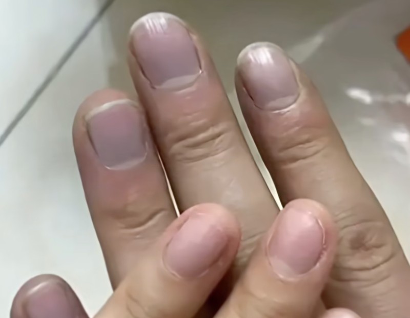  指甲发紫的生理机制与心血管预警：从临床病例到自我检测的系统指南 健康养生