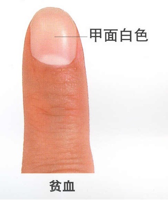  指甲发紫的生理机制与心血管预警：从临床病例到自我检测的系统指南 健康养生