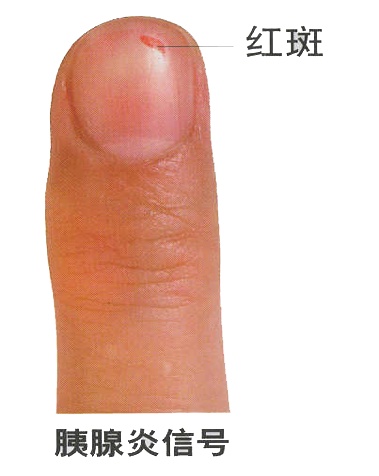  指甲发紫的生理机制与心血管预警：从临床病例到自我检测的系统指南 健康养生