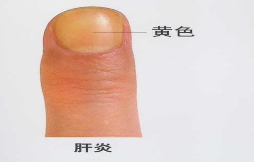  指甲发紫的生理机制与心血管预警：从临床病例到自我检测的系统指南 健康养生