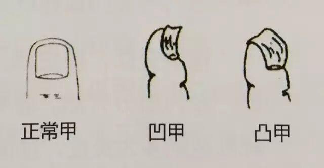  指甲发紫的生理机制与心血管预警：从临床病例到自我检测的系统指南 健康养生