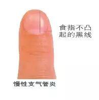  指甲发紫的生理机制与心血管预警：从临床病例到自我检测的系统指南 健康养生